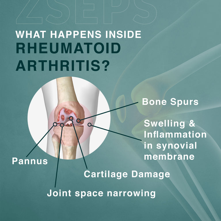 ZSEPS Rheumatoid arthritis care kit